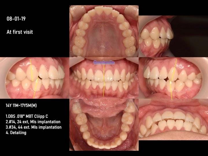 Treatment of skeletal Class II with hyperdivergent…