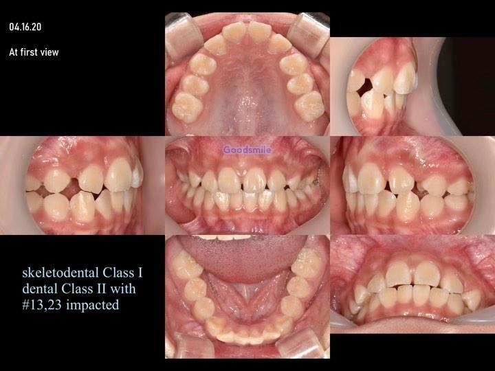 Treatment of dental Class II with bilateral horizo…