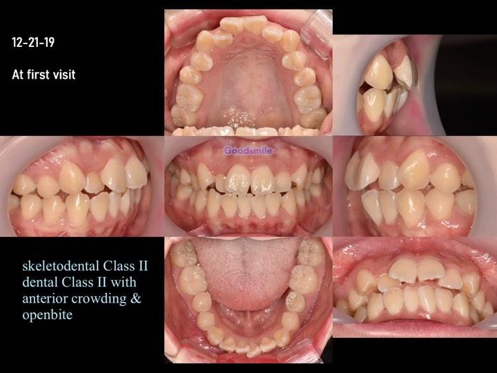 Treatment of skeletodental Class II, dental Class …