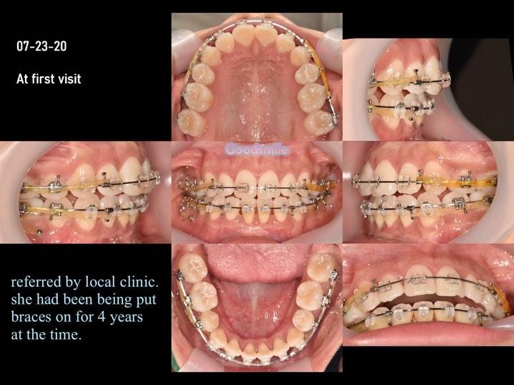 Retreatment due to first orthodontist quitting ort…