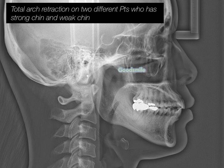Different treatment effects of total arch retracti…