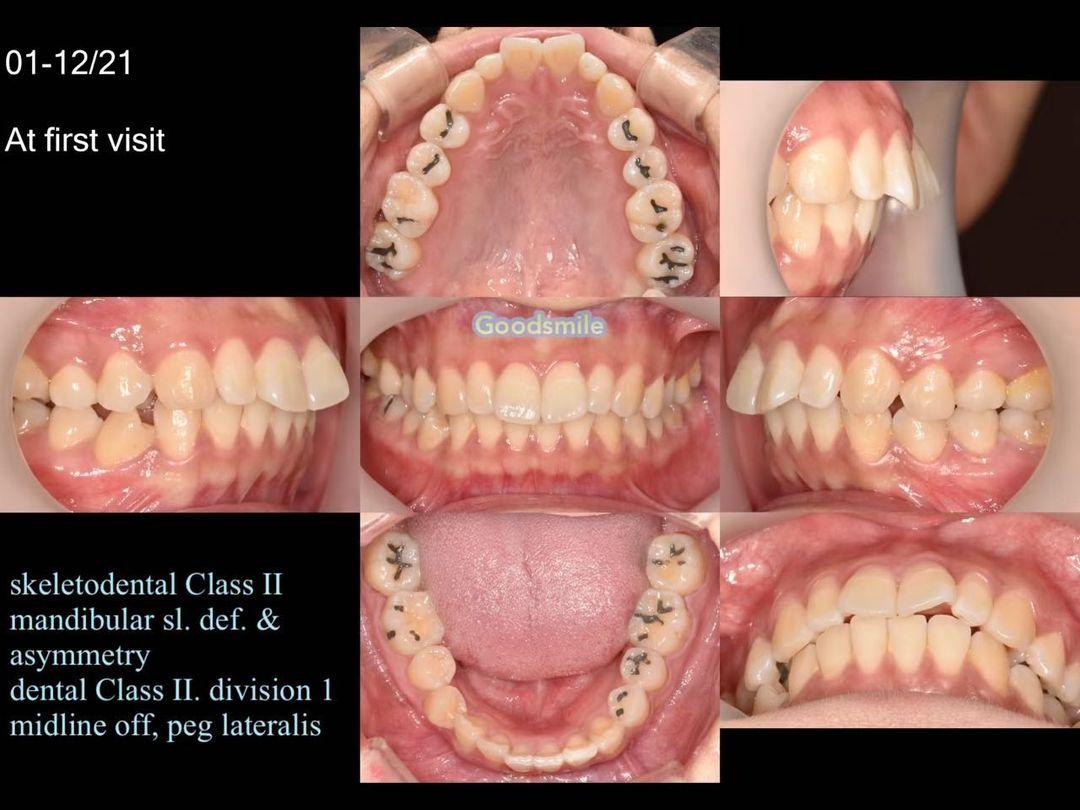 Treatment of dental Class II, division 1 with micr…