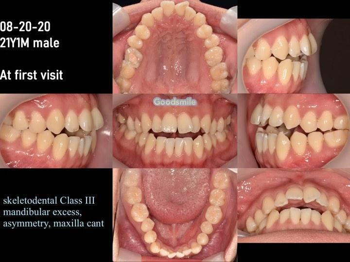 Treatment of skeletal Class III, dental Class I wi…