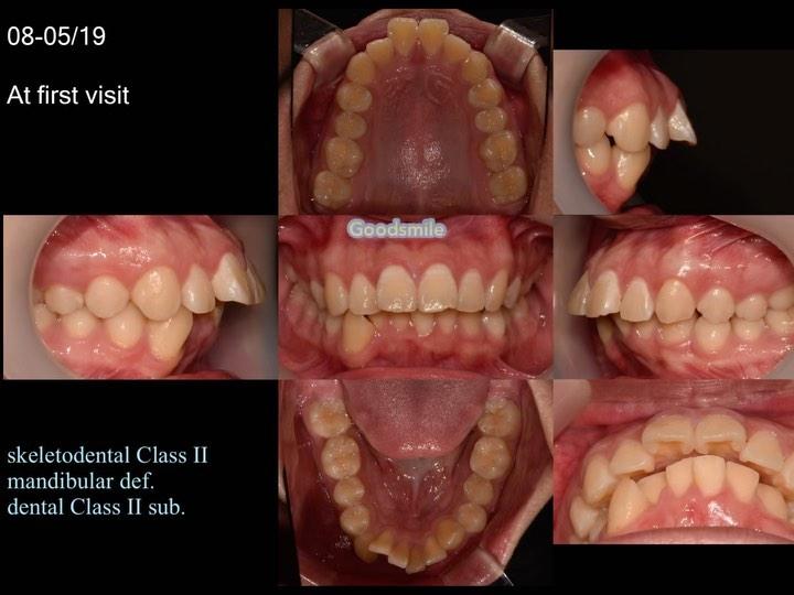 Treatment of skeletodental Class II with lipprotru…