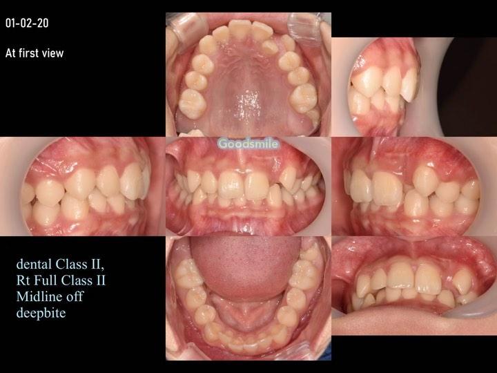 Treatment of dental Class II with MARPE, molar dis…