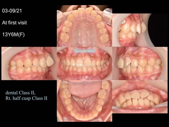 Treatment of dental Class II subdivision Right sid…