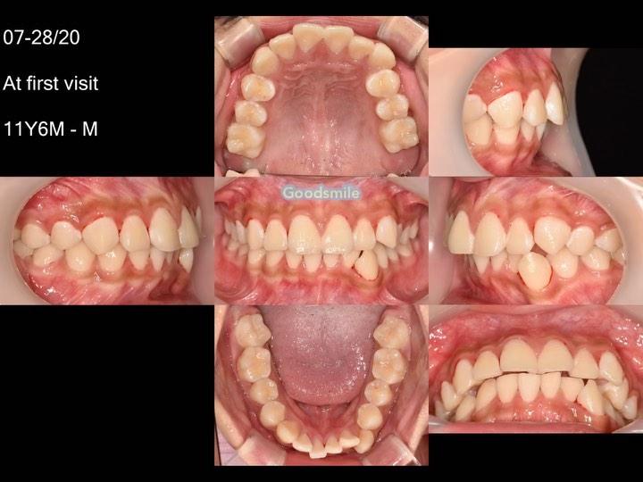 Treatment of skeletal Class II, dental Class I wit…