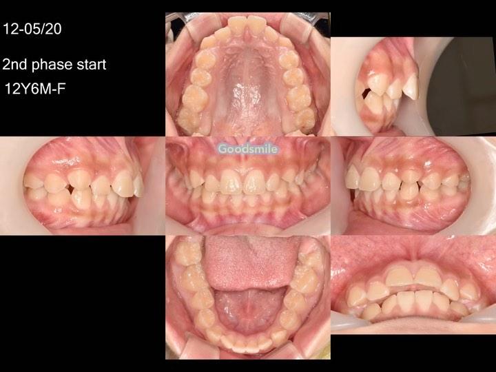 Treatment of dental Class II with anterior crowdin…