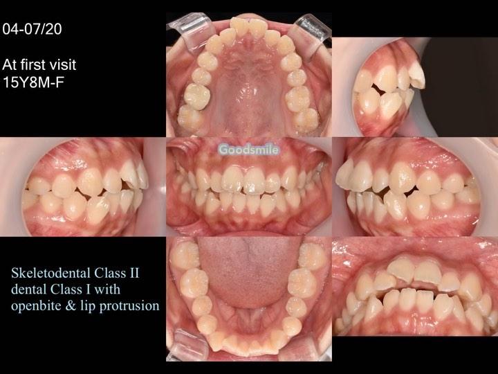 Treatment of skeletal Class II with mandibular def…