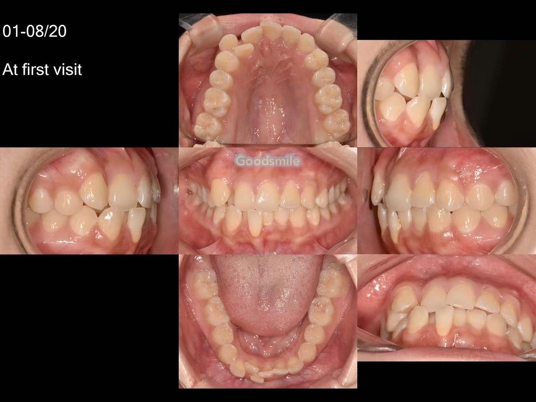 Treatment of dental Class II with anterior crowdin…