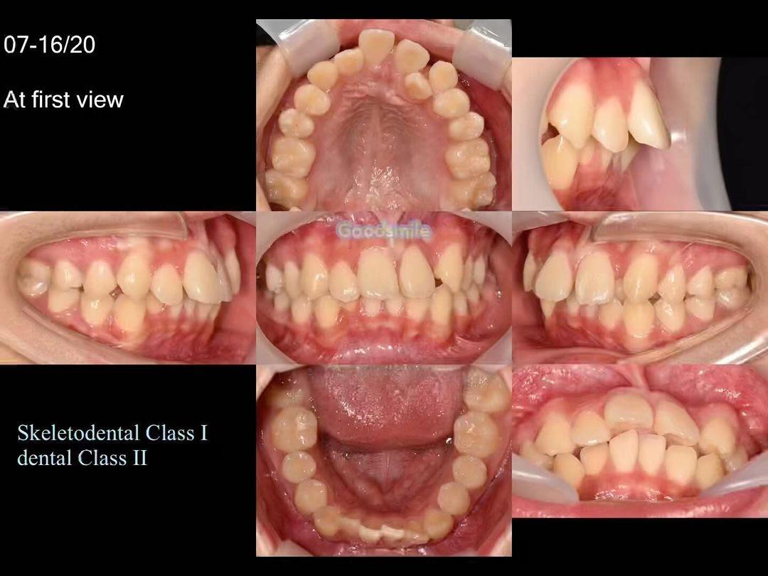 Treatment of dental Class II
1. DBS .018” MBT
2. …