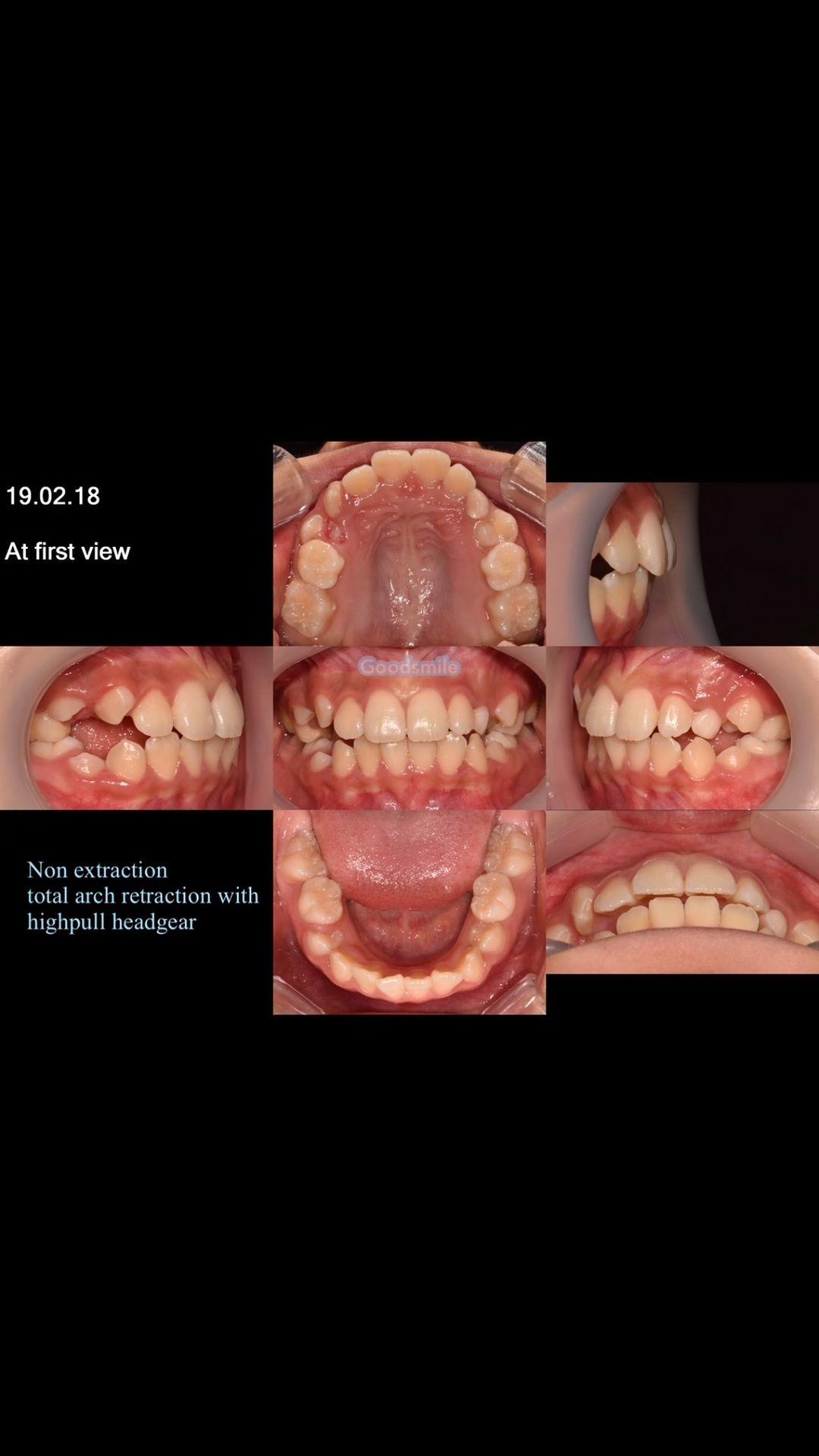 Treatment of dental Class II with highpull headgea…