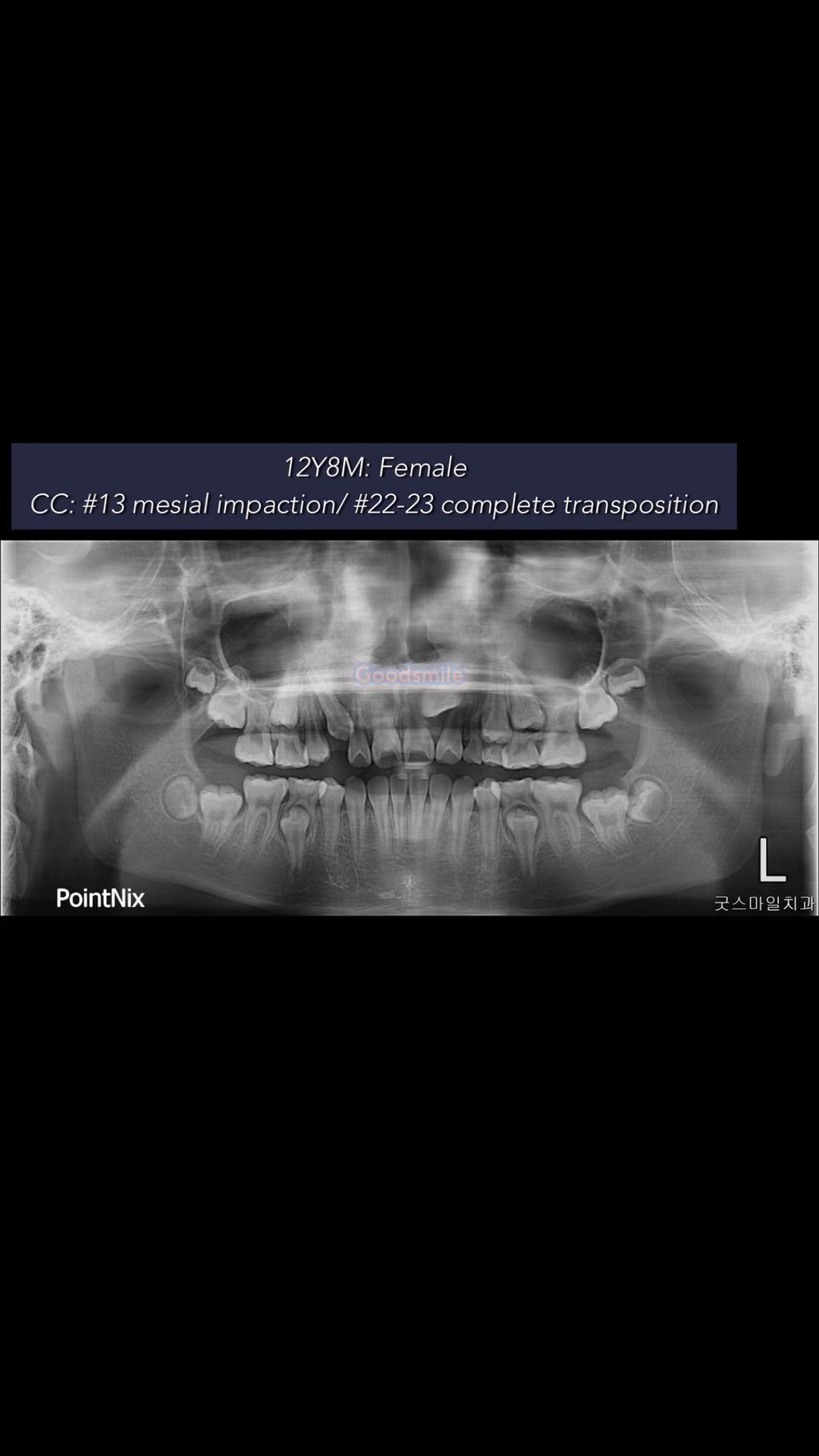 Treatment of complete transposition case,
skeletod…