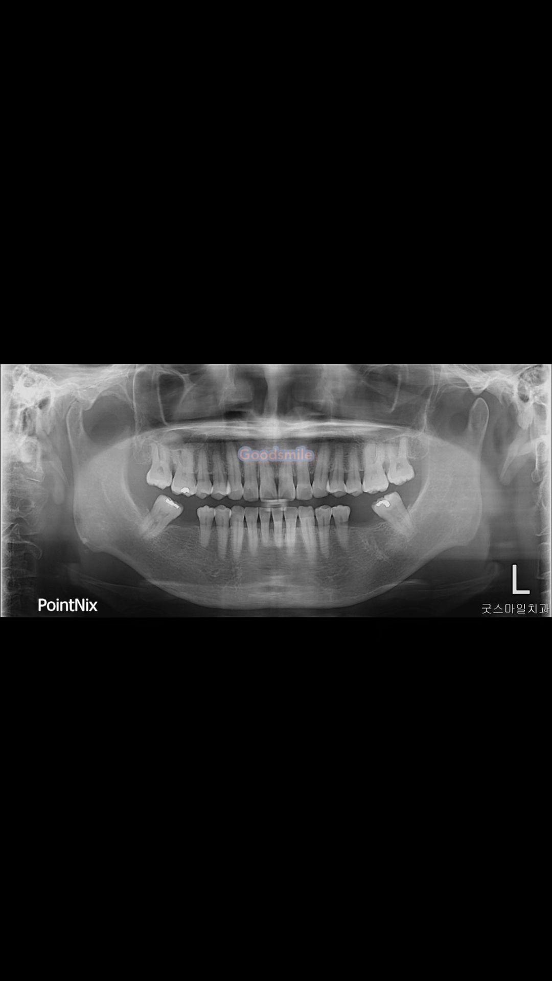 Uprighting of both mandibular 2nd molars with limi…