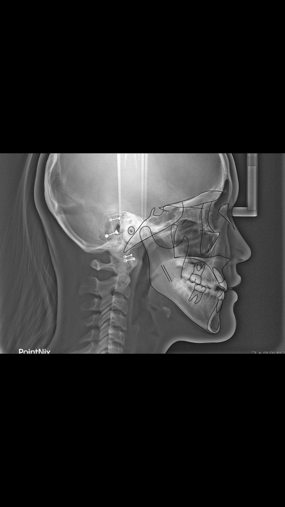 Treatment of Class III without compromising of goo…