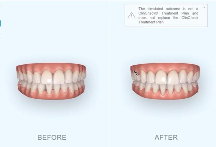 After treatment
vs
automatic set up…