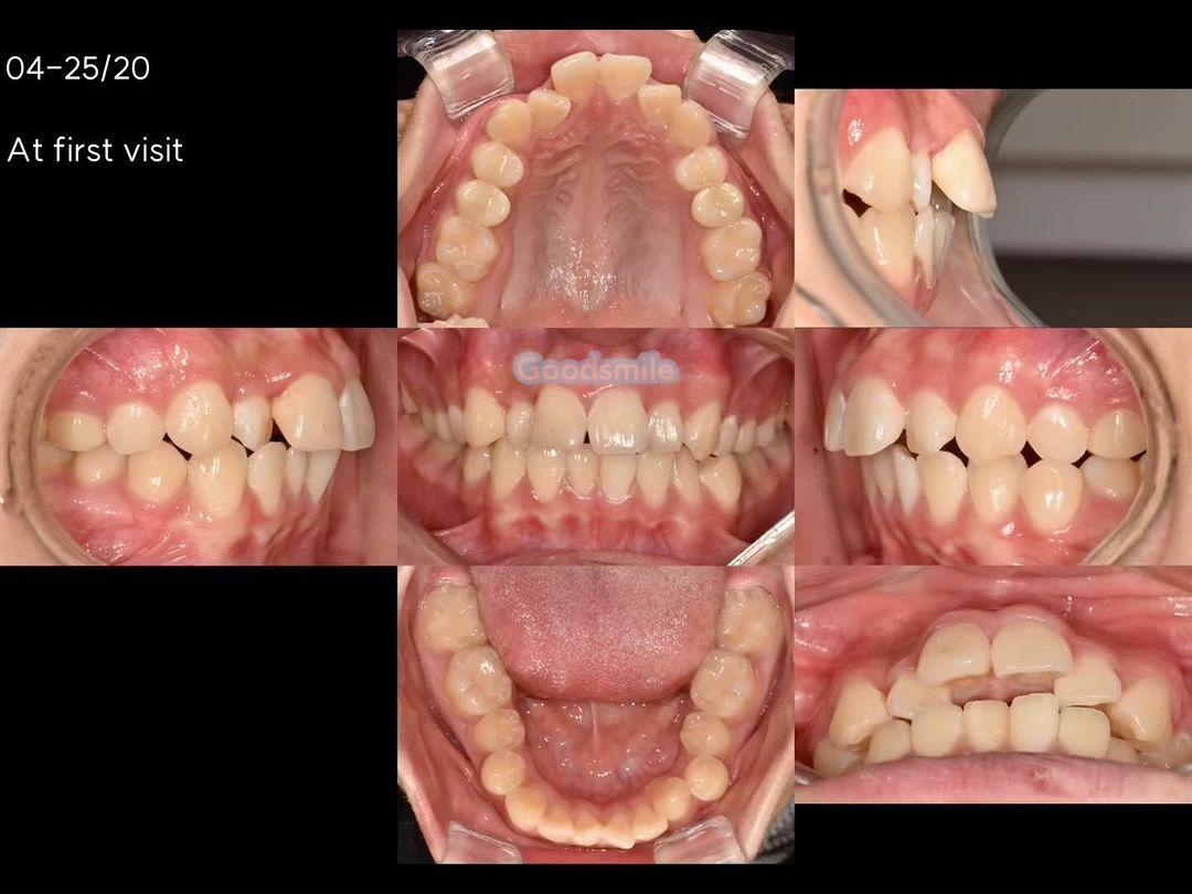 Treatment of skeletal Class II, dental Class II
1…