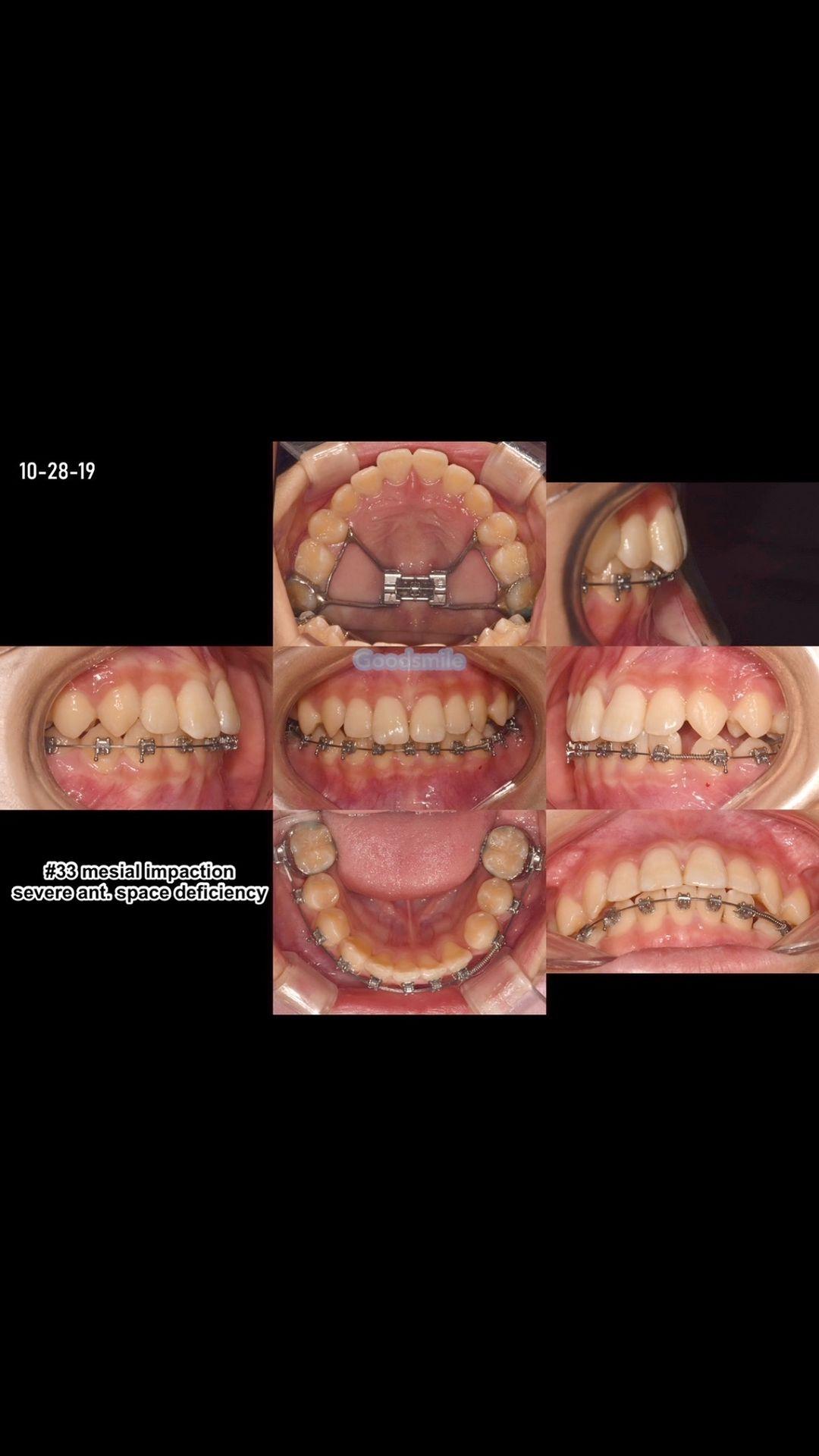 Treatment of impacted lower canine without extract…