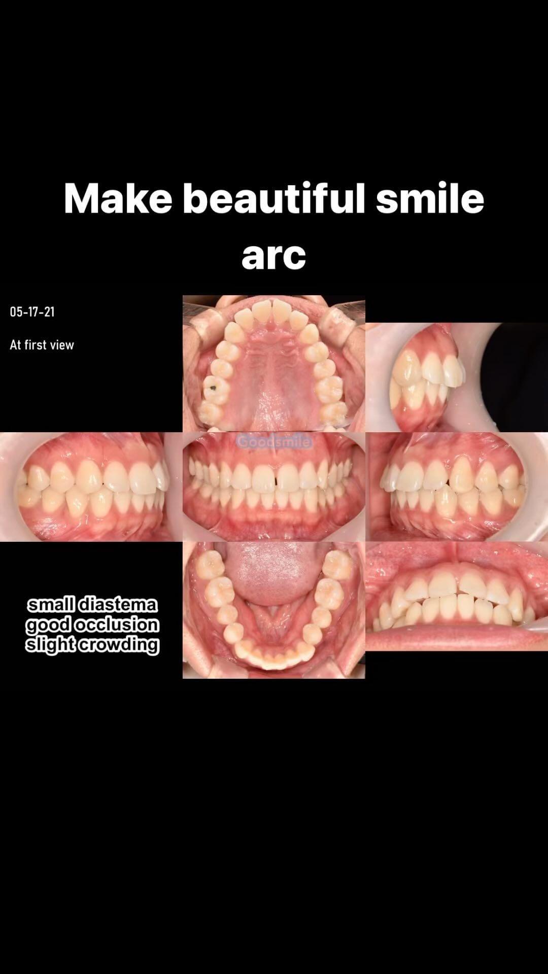 Treatment based on smile arc concept
Do you think…