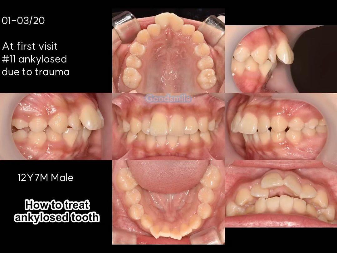 Treatment of skeletodental Class II malocclusion w…