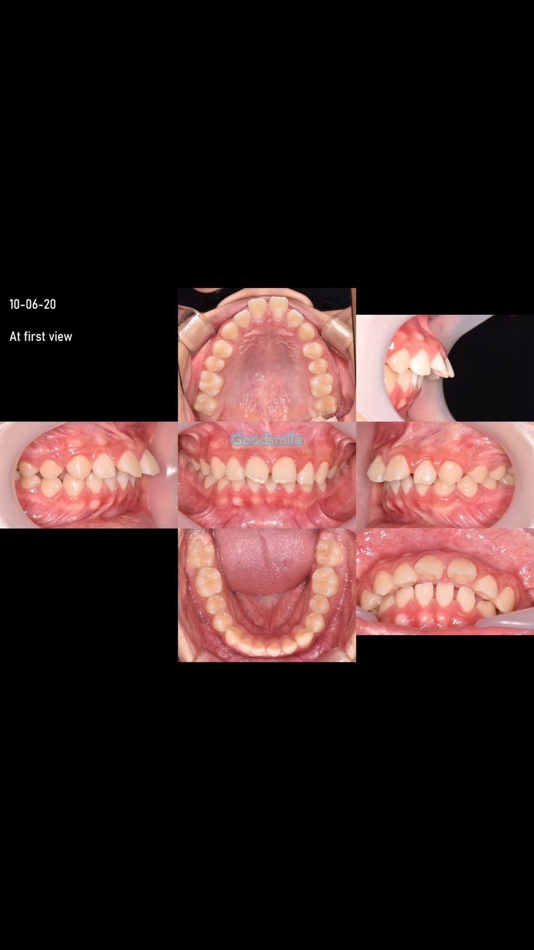 Camouflage treatment of skeletal Class II, dental …