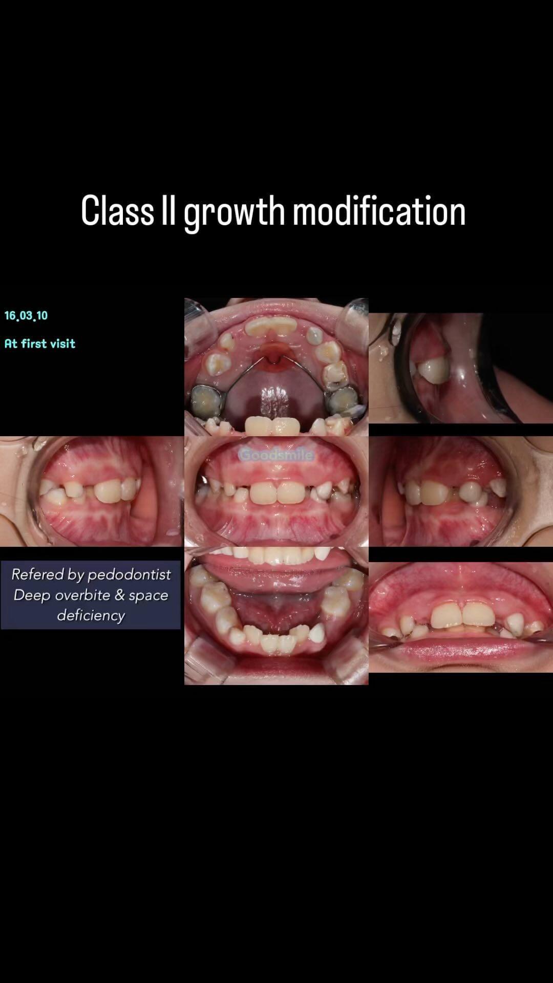 Treatment of skeletodental Class II, dental Class …