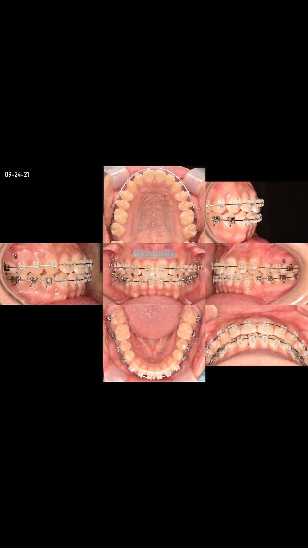 Camouflage treatment of skeletodental Class III ma…