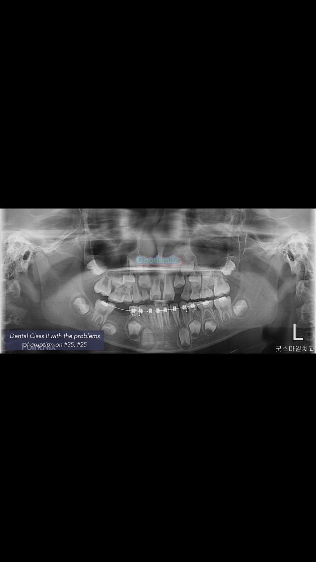 Early treatment of dental Class II with severe eru…