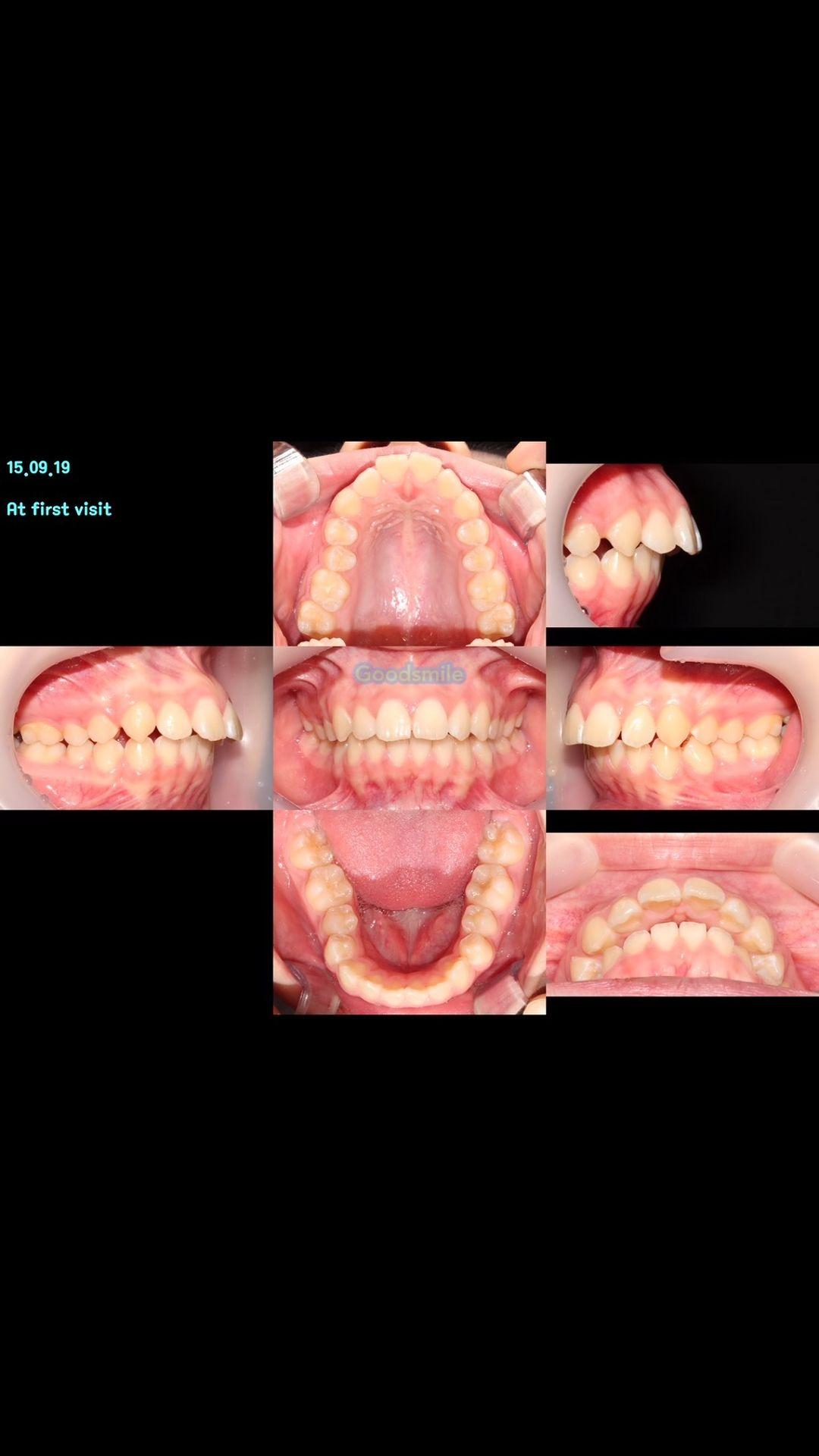 2-phase treatment???
At first treatment, a patien…