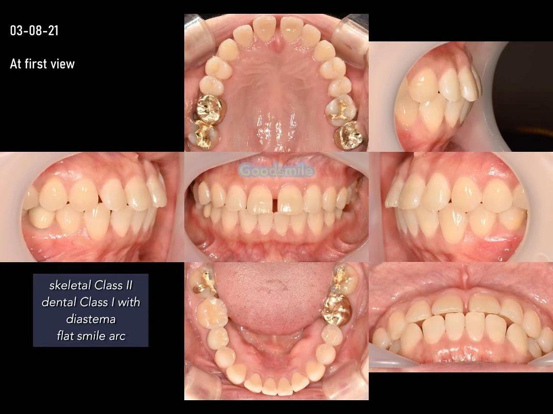treatment of dental Class I with spacing based on …