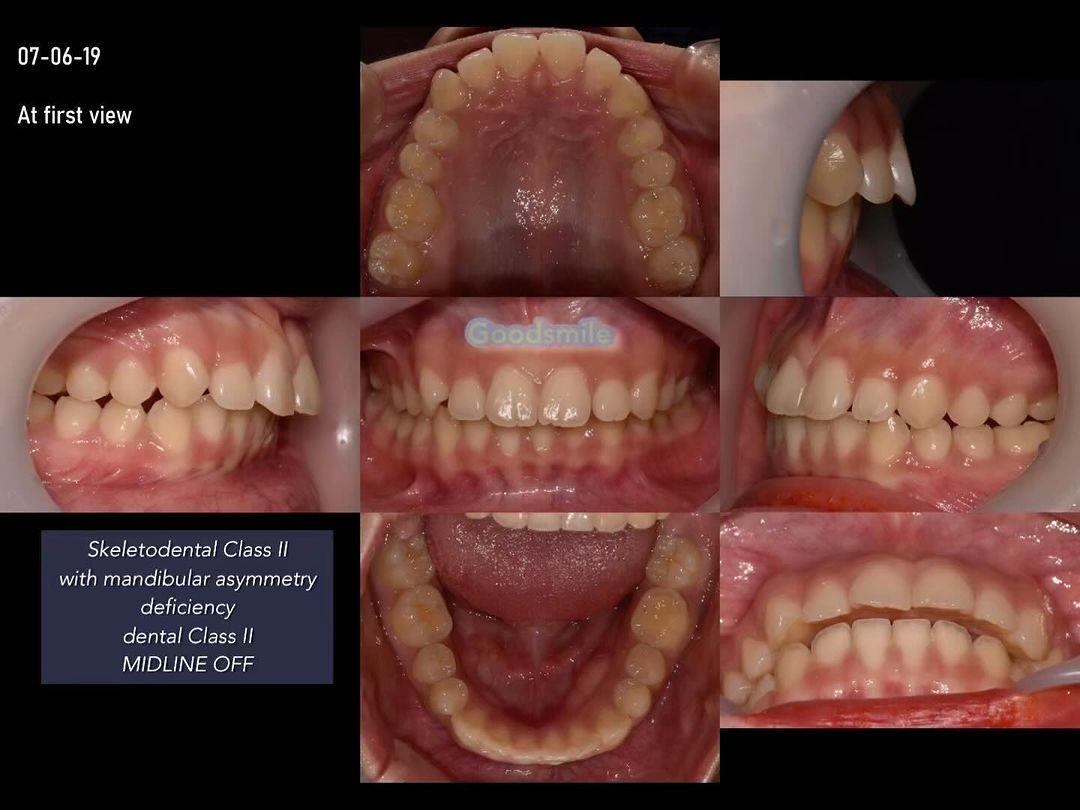 Non surgical Camouflage treatment of skeletodental…