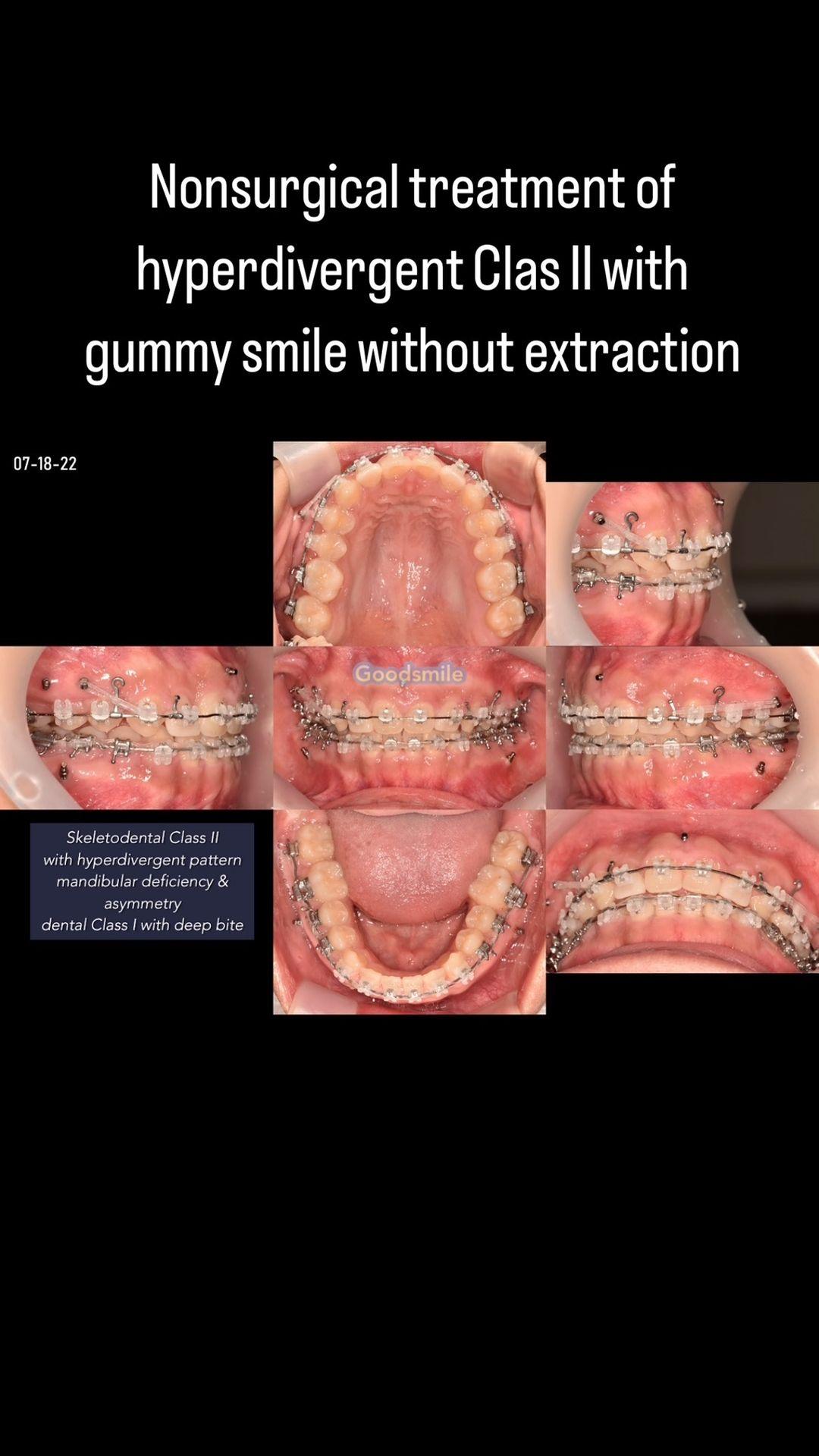 Non surgical treatment of skeletodental Class II w…