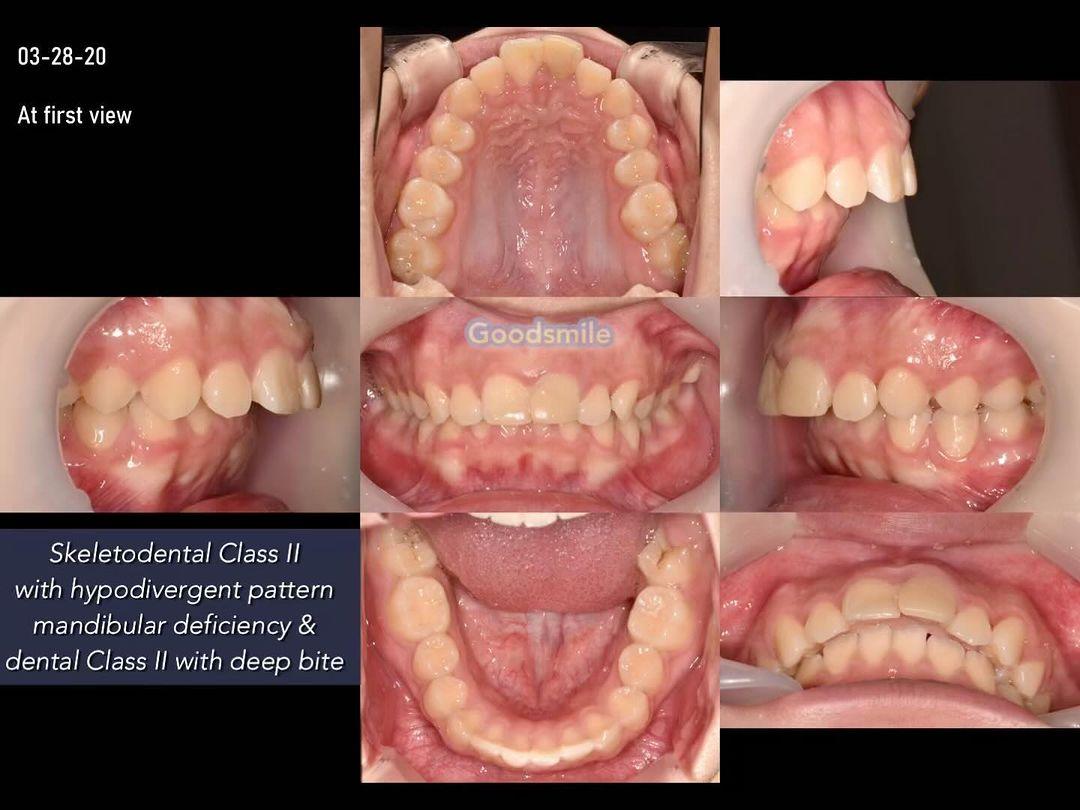 Non-extraction treatment of skeletodental dysplasi…