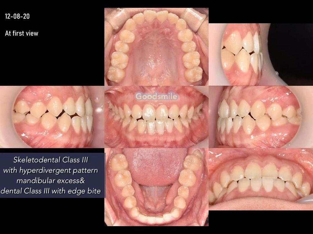 Nonsurgical treatment of skeletodental dysplasia, …