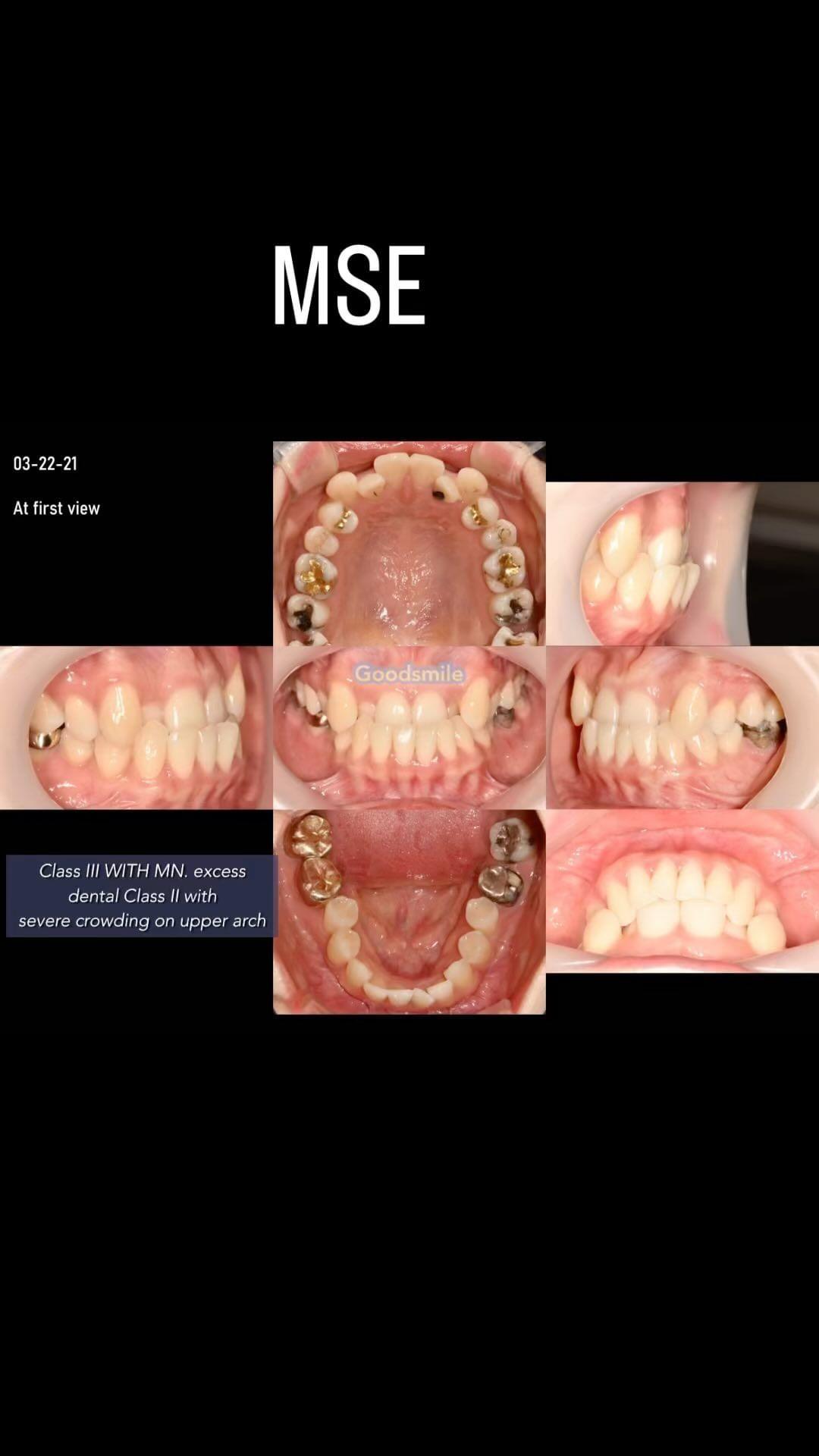 Camouflage treatment of skeletal Class III with ma…