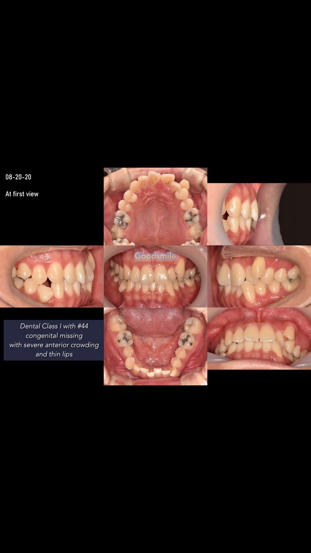 Treatment of dental Class I with anterior severe c…