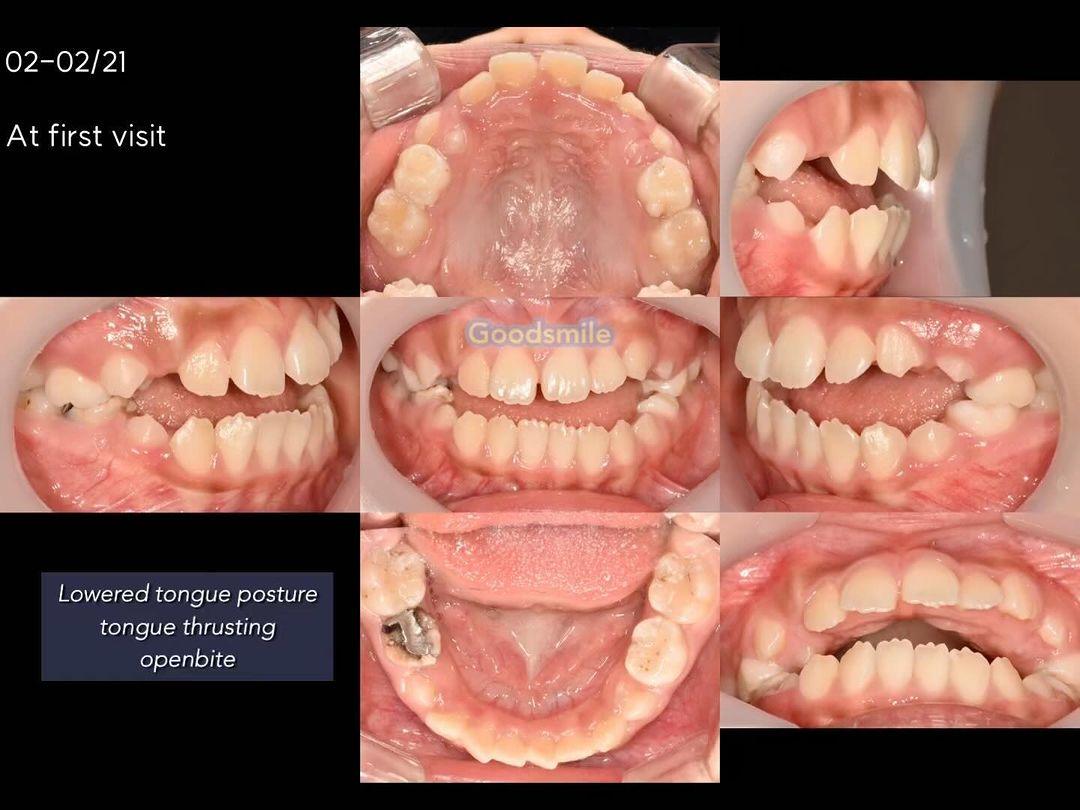 Shut down -open bite due to lowered tongue posture…