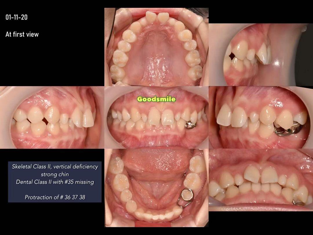 Unilateral molar protraction to correct congenital…