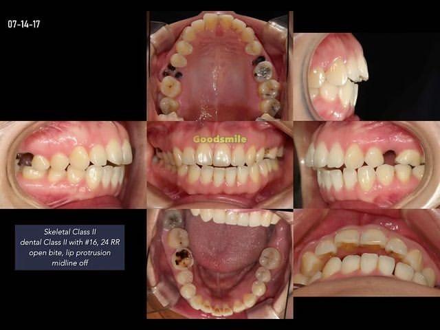 Camouflage treatment of skeletodental Class II wit…