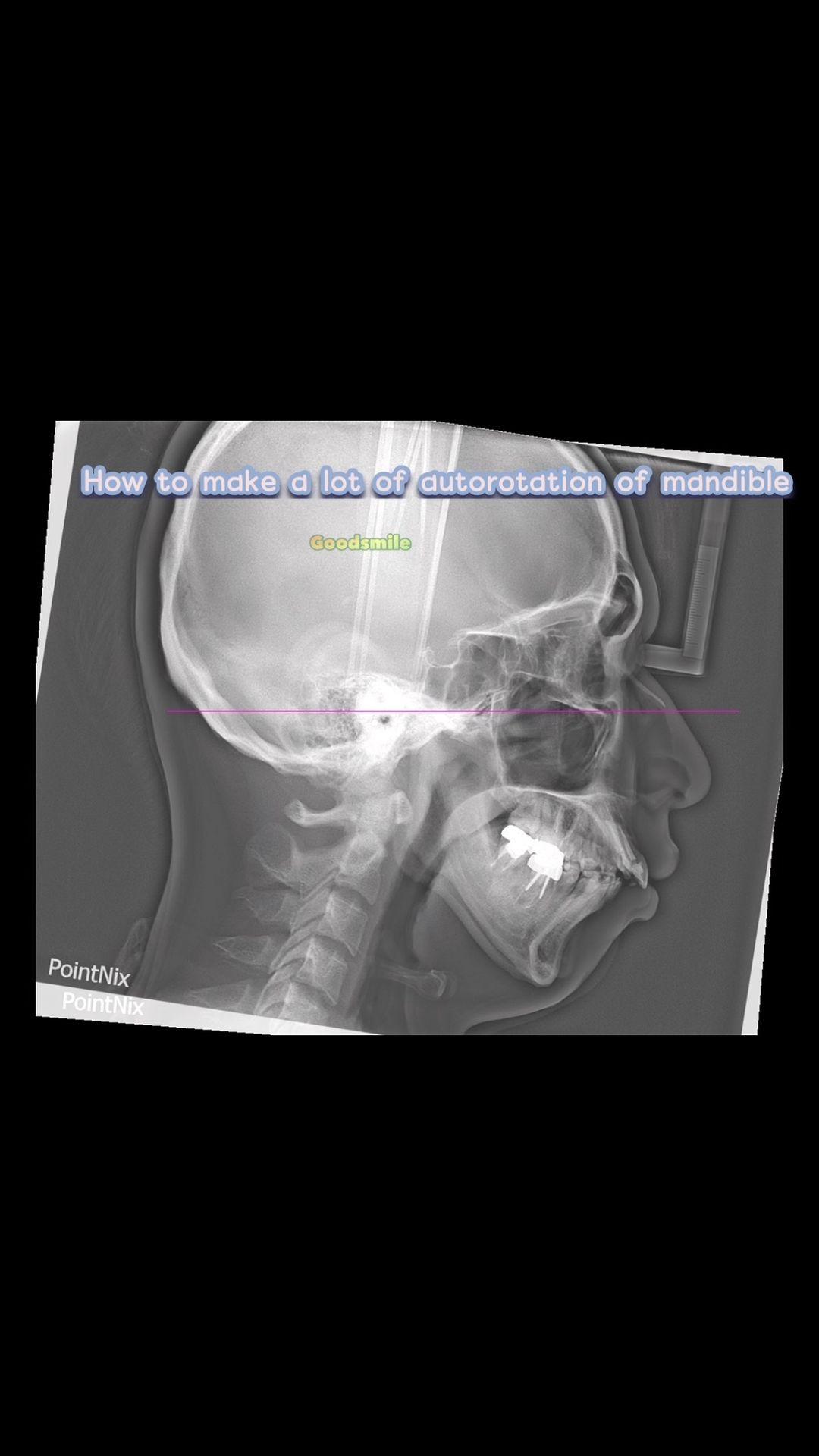 How to make significant mandibular autorotation in…