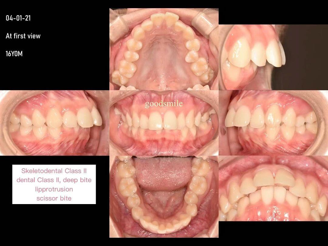 Camouflage treatment of skeletodental Class II, de…
