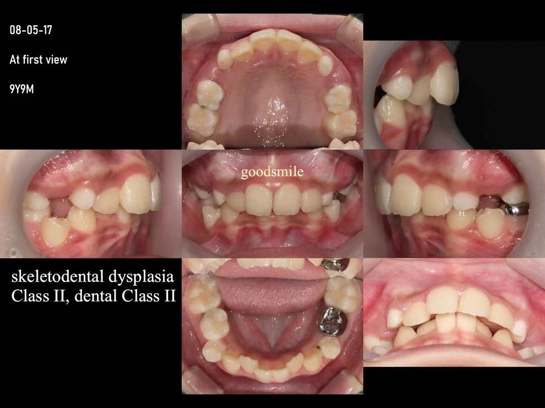 Treatment of skeletal Class II, mandibular deficie…