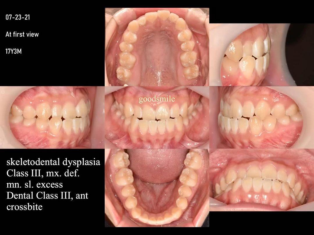 Camouflage treatment of skeletodental Class III, d…