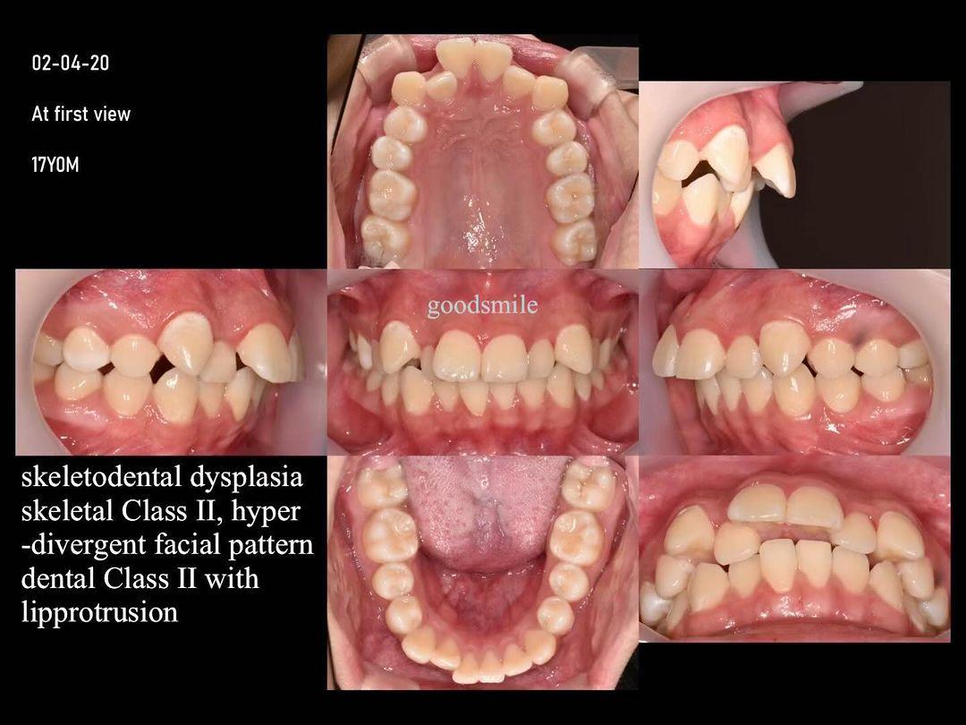 Camouflage treatment of skeletal Class II, hyperdi…