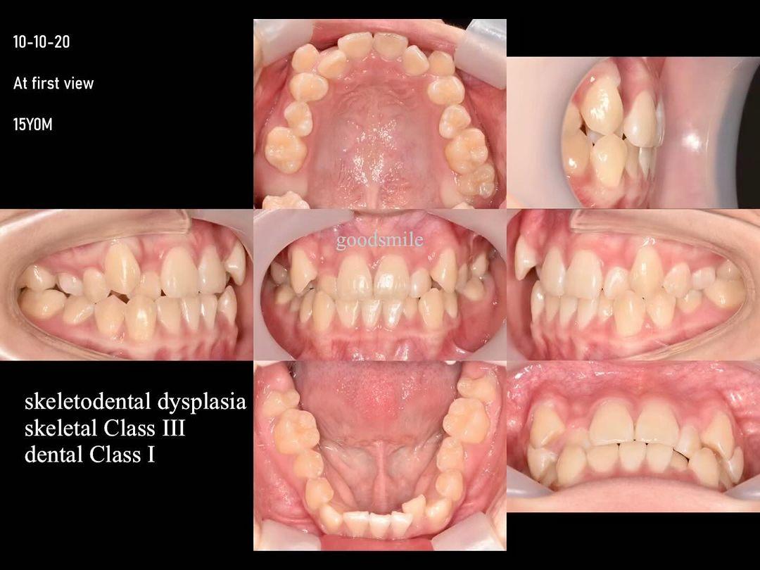 Camouflage treatment of skeletal Class III, dental…