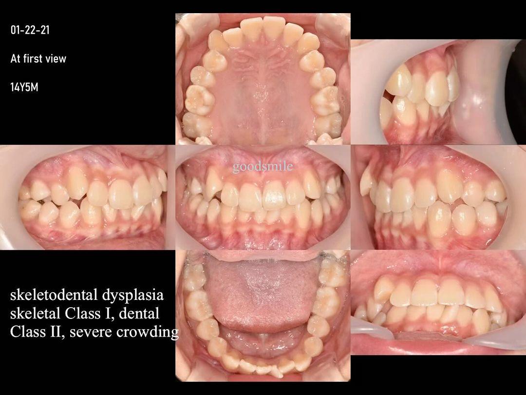 Camouflage treatment of dental Class II with sever…