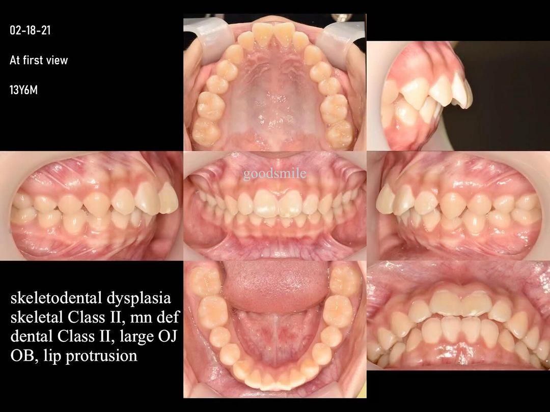 Treatment of skeletodental Class II, dental Class …