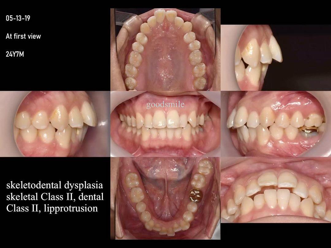 Camouflage treatment of skeletal Class II, hyperdi…