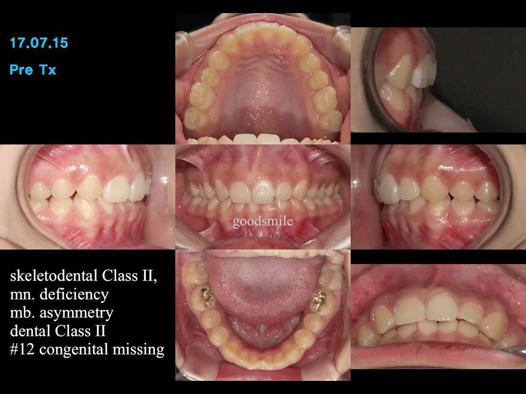Camouflage treatment of skeletal asymmetry, dental…