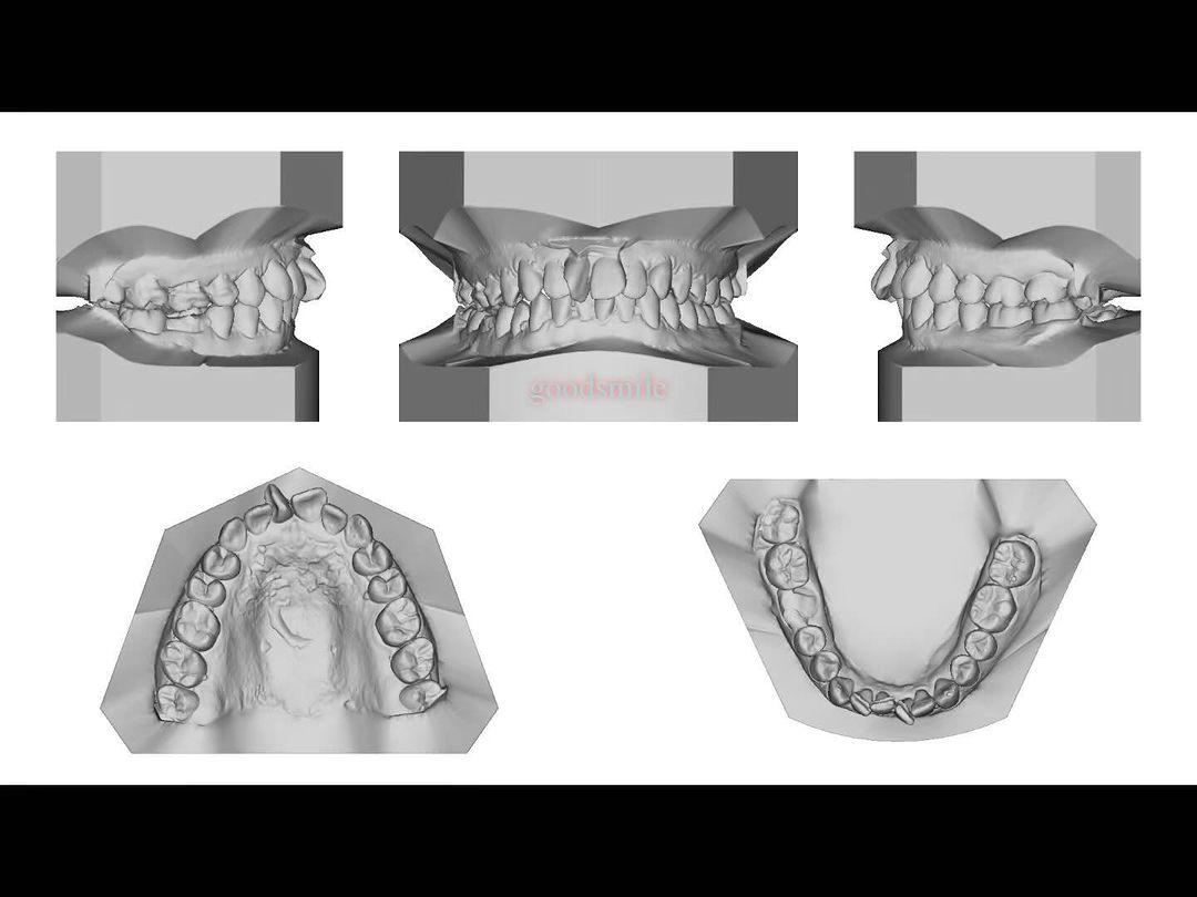 Camouflage treatment of skeletal Class II, dental …